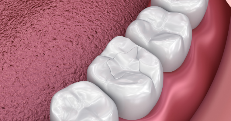 dental sealants covering 